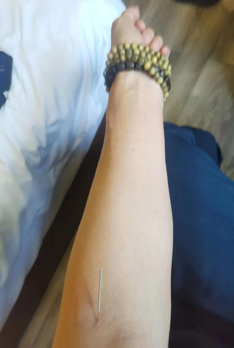 用针灸穴位治疗感冒