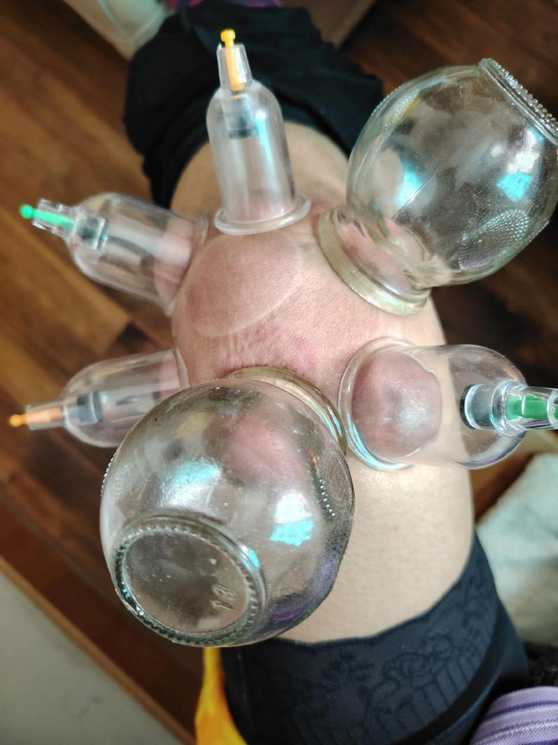 风湿膝盖疼可以拔火罐