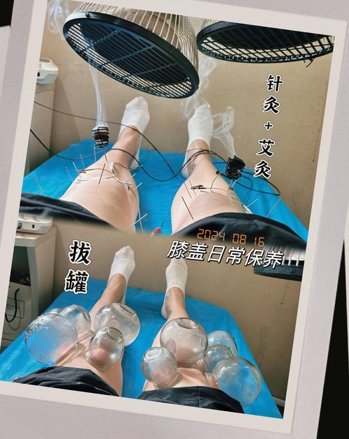 风湿膝盖疼可以拔火罐