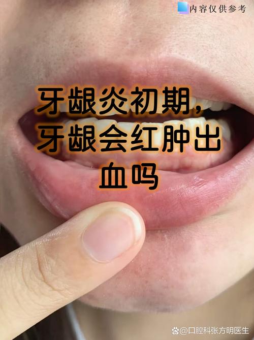 脑梗牙龈出血怎么回事