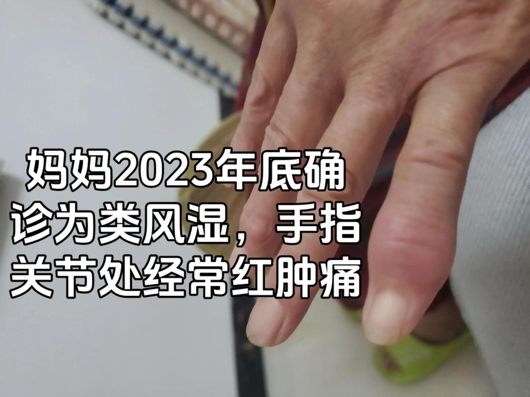 产后风湿手指肿胀晨僵