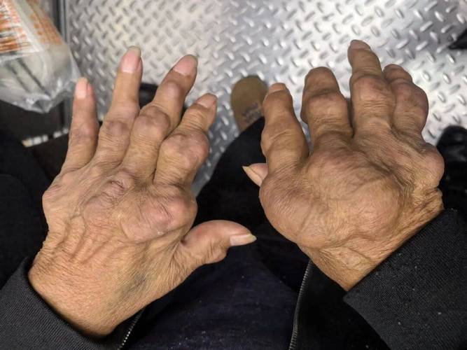 类风湿手脚变形的图片