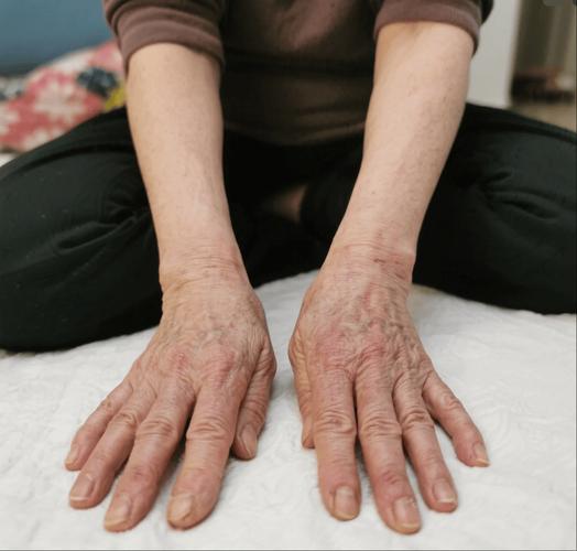 类风湿手脚变形的图片