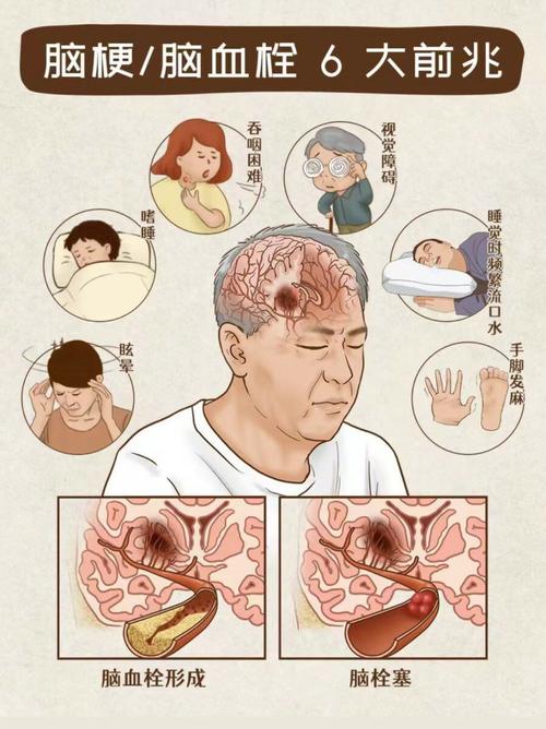 缺血脑梗的症状有哪些
