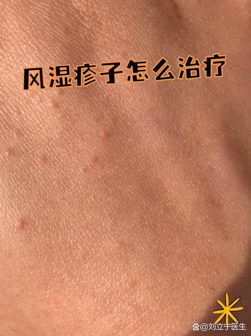 全身风湿疙瘩怎么回事