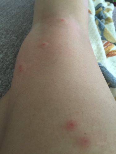 全身风湿疙瘩怎么回事