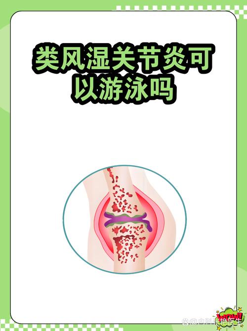 类风湿夏天可以游泳吗