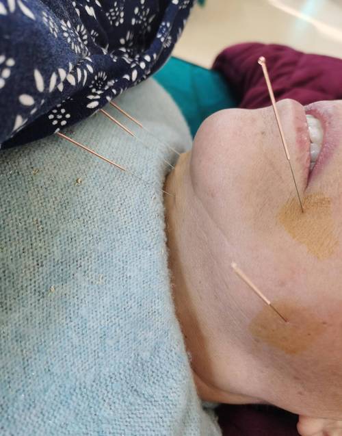 针灸治疗脑梗效果好吗