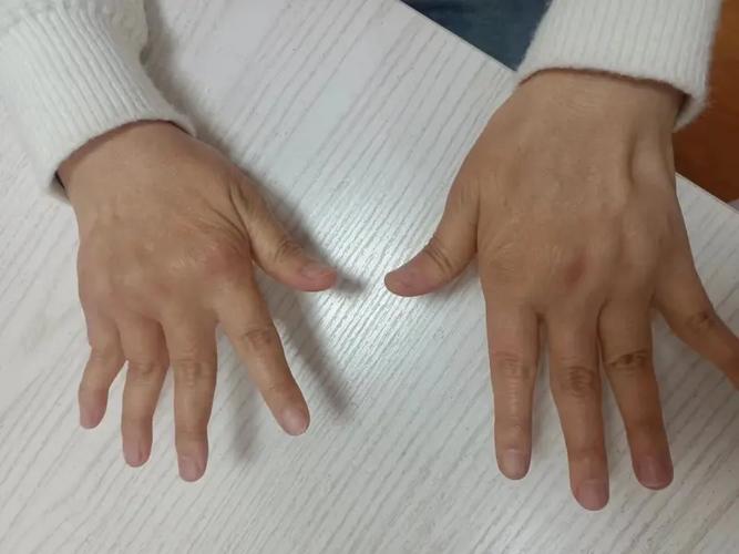 手腕疼类风湿变形图片