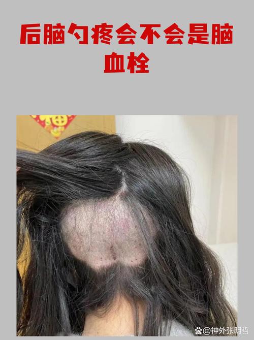 老人后脑勺疼是脑梗吗