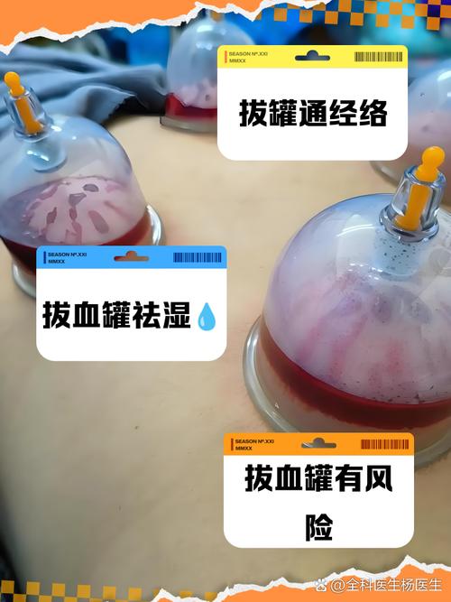 孕妇风湿可以拔火罐吗