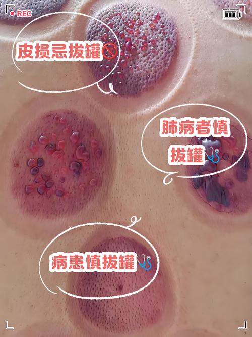 孕妇风湿可以拔火罐吗