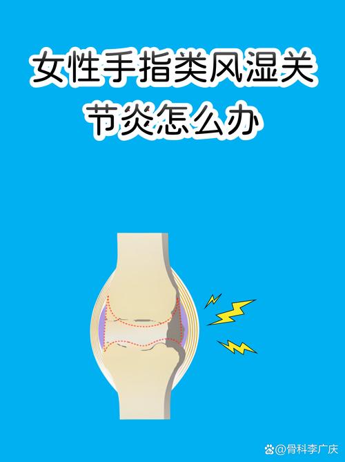 东莞类风湿哪个医生好