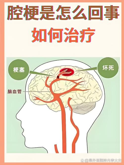 腔隙脑梗不复发的经验