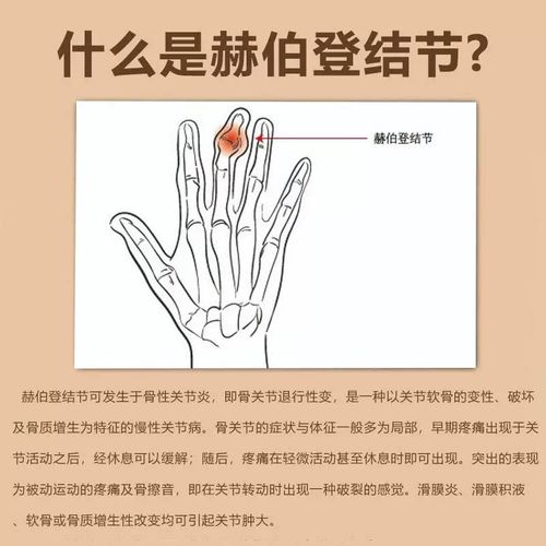 手关节风湿用什么药膏