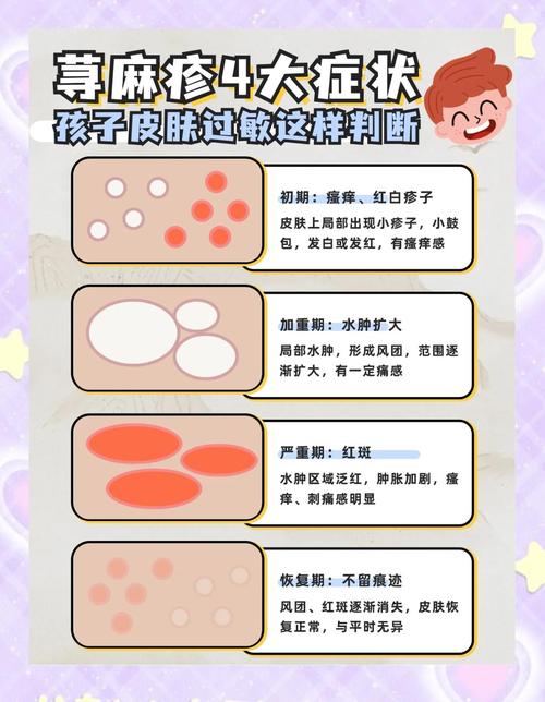 儿童风湿疙瘩怎么回事