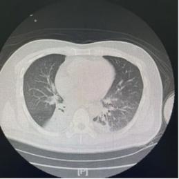 脑梗肺部感染会死人吗