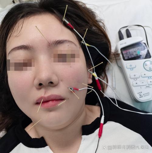 面瘫可以注射穴位针