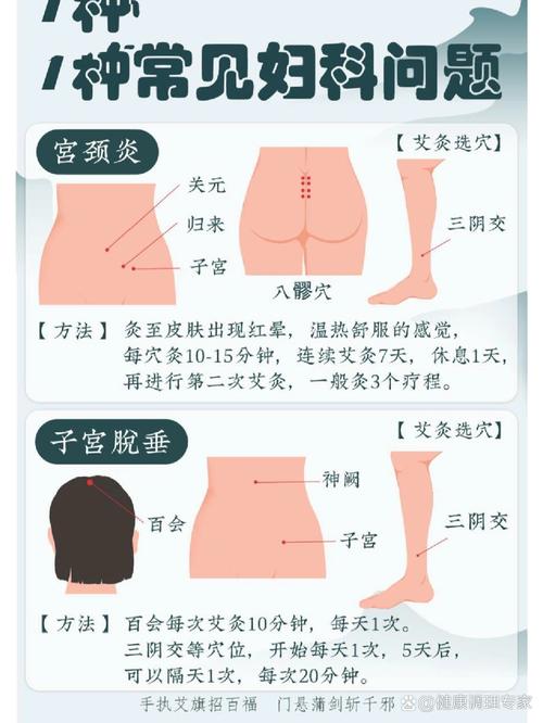 宫颈糜烂灸那些穴位