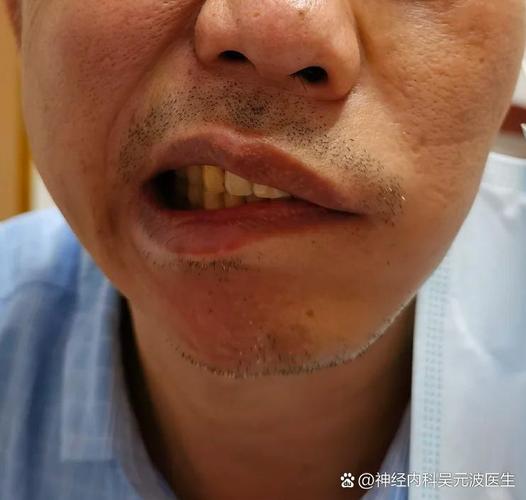 脑梗嘴歪了病情严重吗