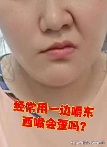 脑梗嘴歪了病情严重吗