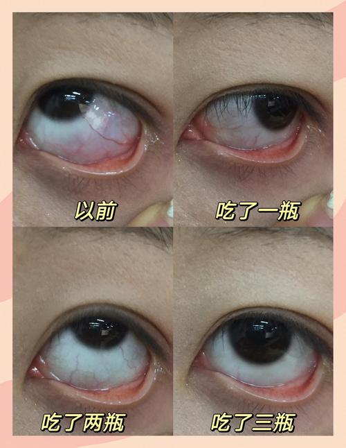 老年人眼睛充血与脑梗