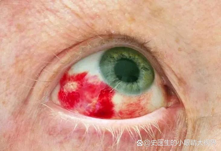 老年人眼睛充血与脑梗