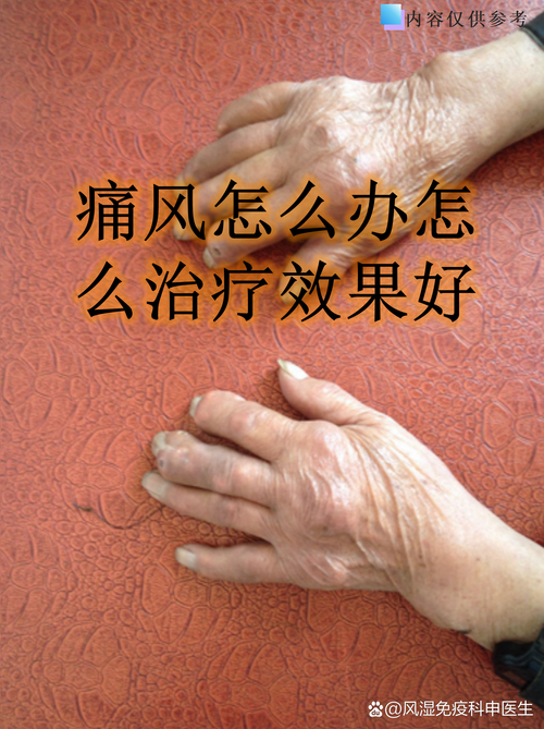 冷风扇吹了会得风湿吗