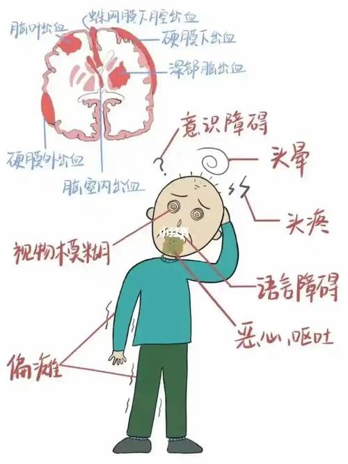 脑梗和脑出血哪个严重