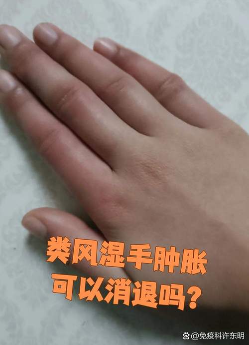 内风湿会引起哪些症状