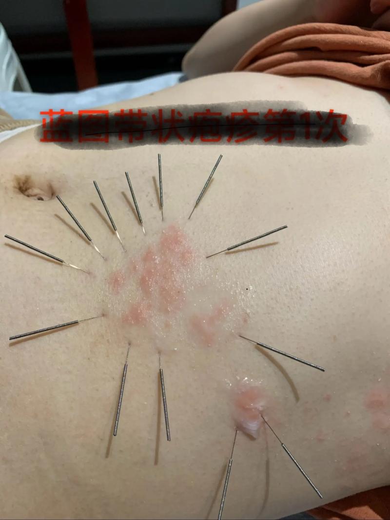 蛇胆疮针灸止痛穴位