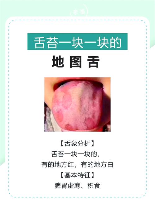 如何判断脑梗的大舌头