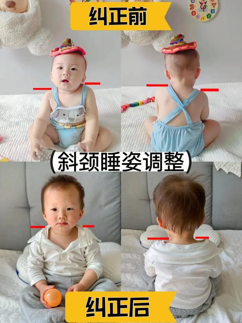 斜颈小儿推拿有穴位