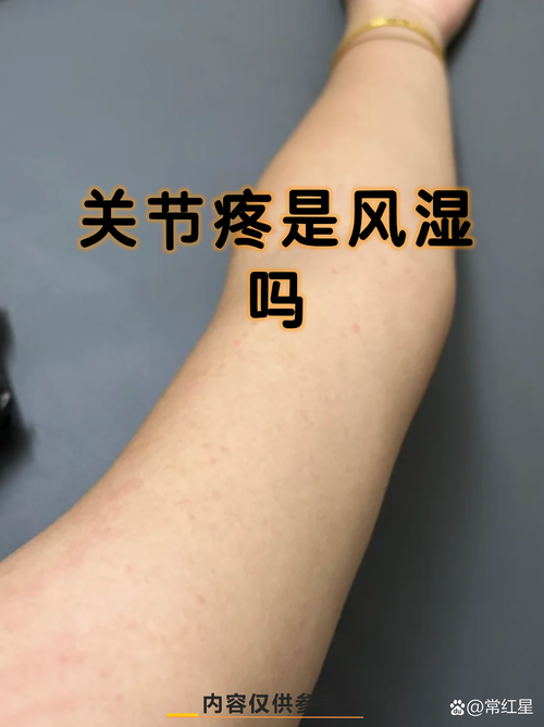 胳膊受凉酸痛是风湿吗