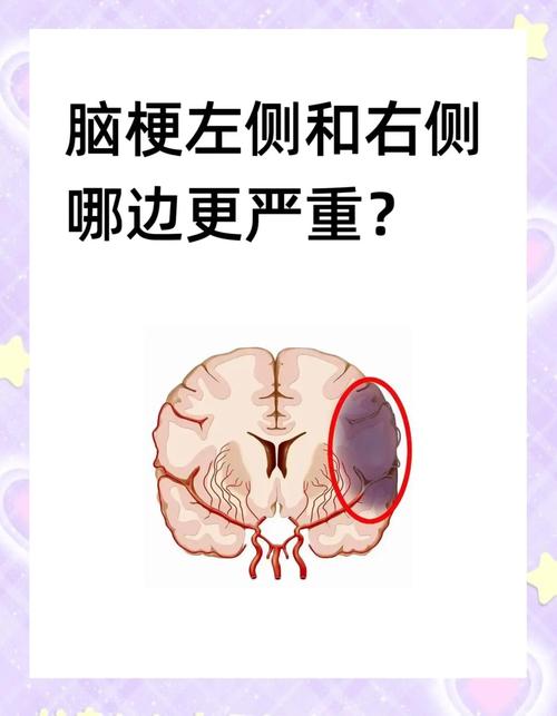 右侧额叶腔梗是脑梗吗