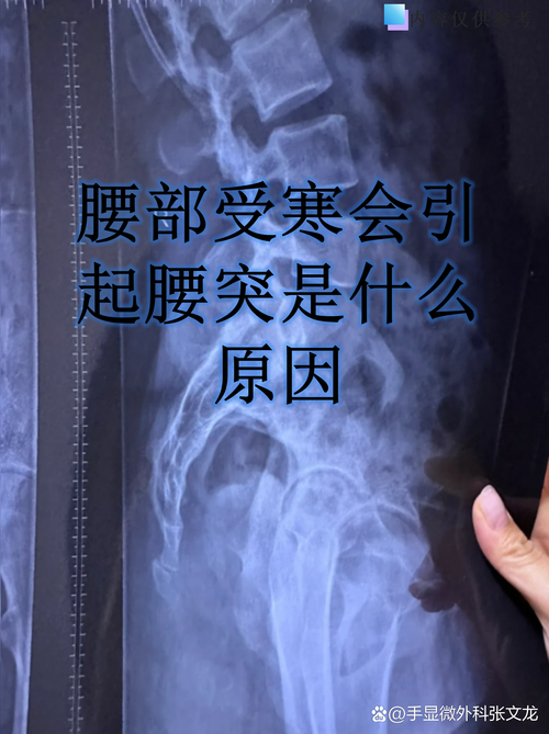 腰椎类风湿的临床症状