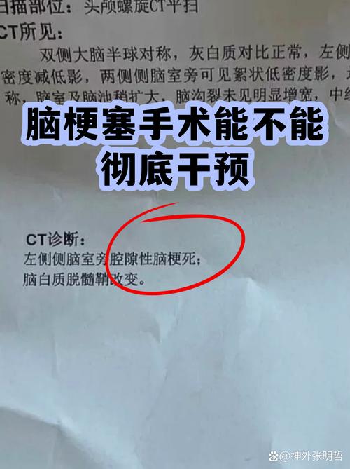 脑梗后多久可以做手术