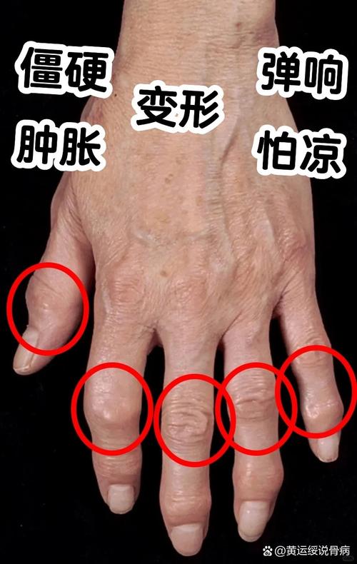 风湿类疾病有什么症状