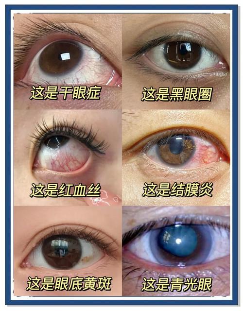 干眼症与风湿有关系吗