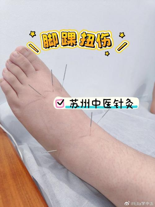 踝关节扭伤穴位针灸