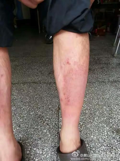 南宁风湿医院治疗贵吗