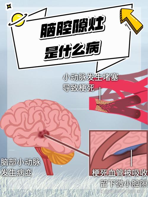 腔隙灶和脑梗有区别吗