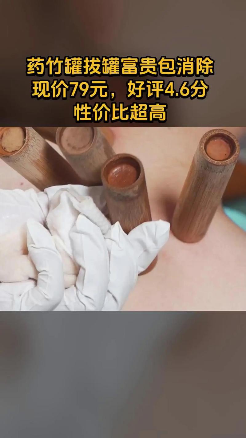 风湿可以拔罐治疗方法