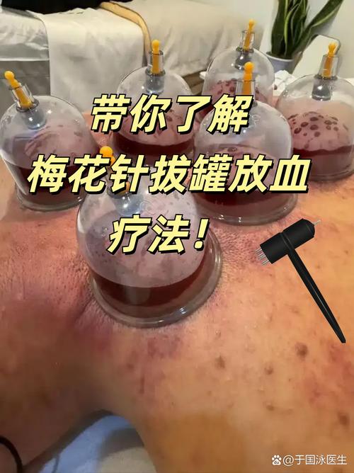 风湿可以拔罐治疗方法