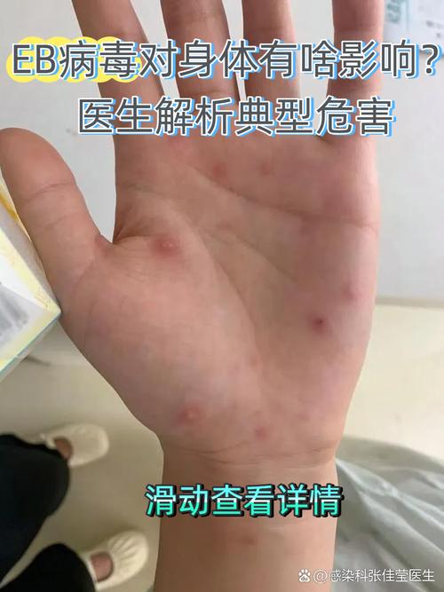 类风湿因子与eb病毒