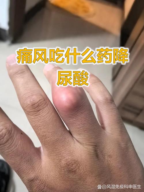 尿酸高是风湿还是痛风