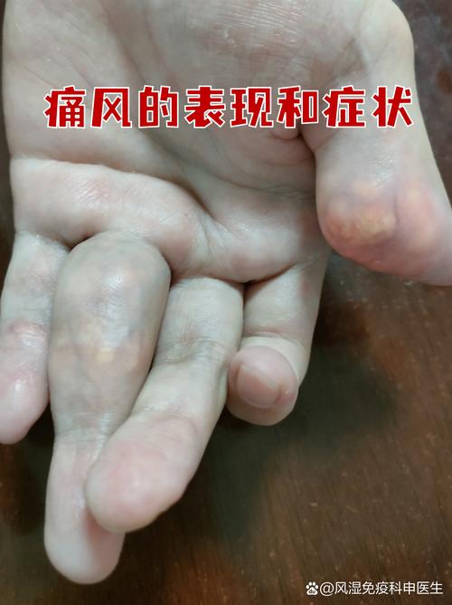 尿酸高是风湿还是痛风