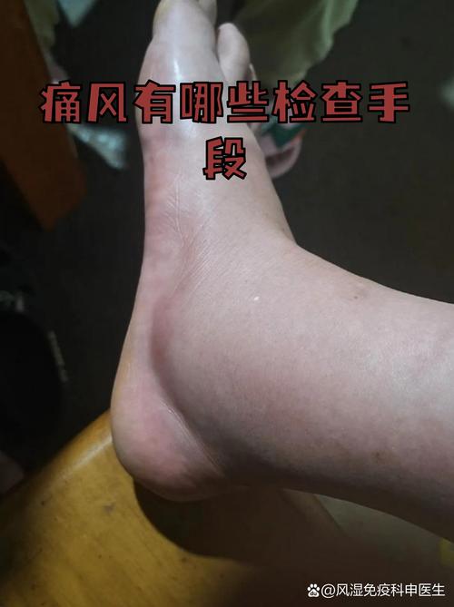 尿酸高是风湿还是痛风
