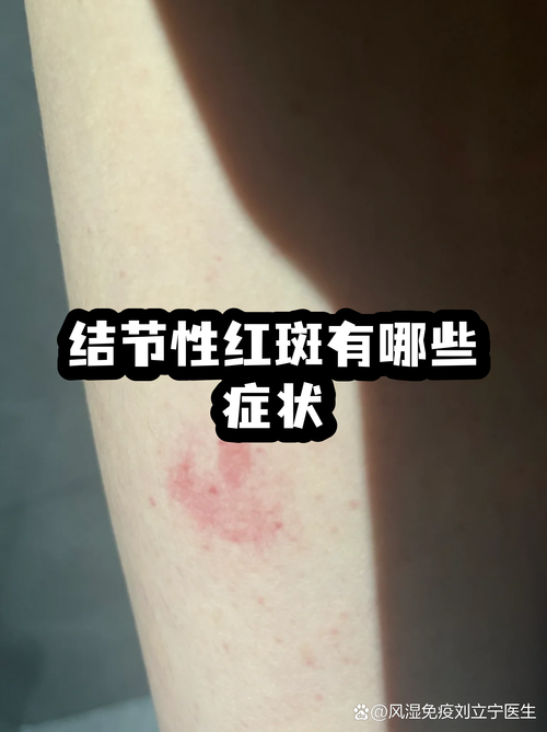 风湿结节红斑怎么治疗