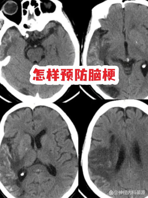 脑梗糖尿病的平均寿命